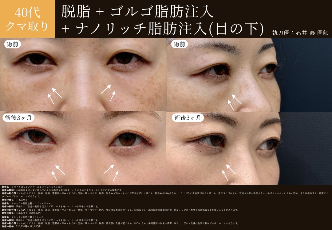 目の下の切らないクマ・たるみ取り